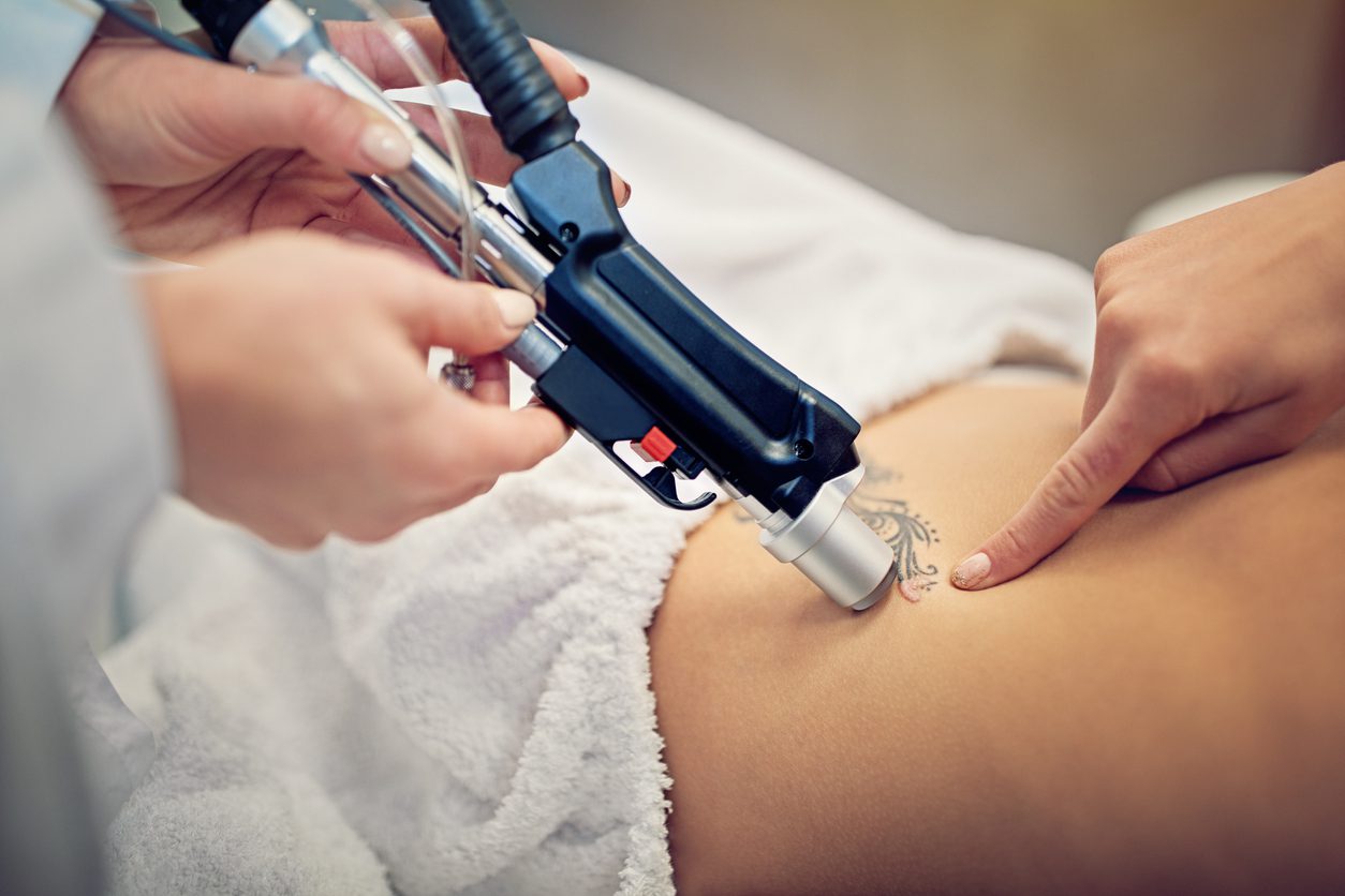 Laser Removal Experts