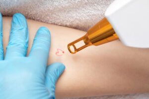 Pain Free Laser Tattoo Removal