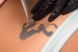 Tattoo Removal