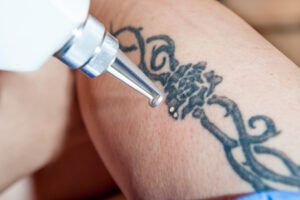 Tattoo Removal Experts