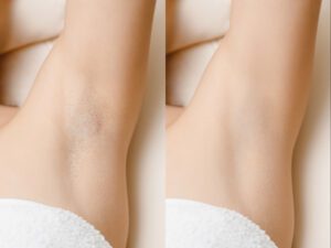 Walsall Laser Hair Removal