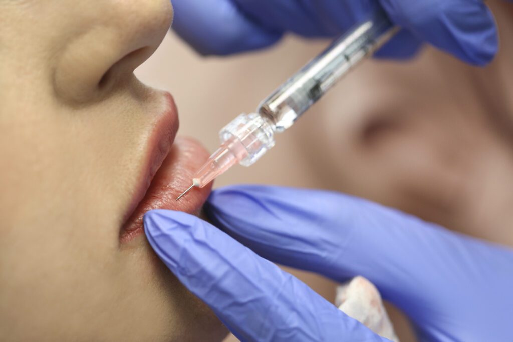 Dermal Fillers Wolverhampton