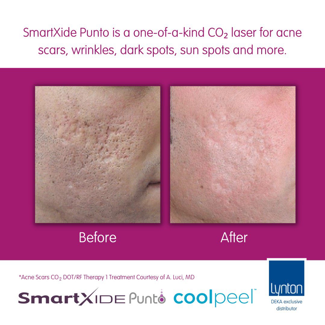 SmartXide Punto Acne Scarring