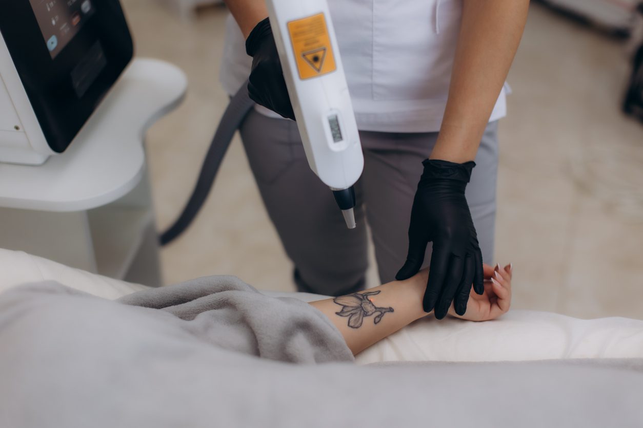 laser-tattoo-removal-walsall